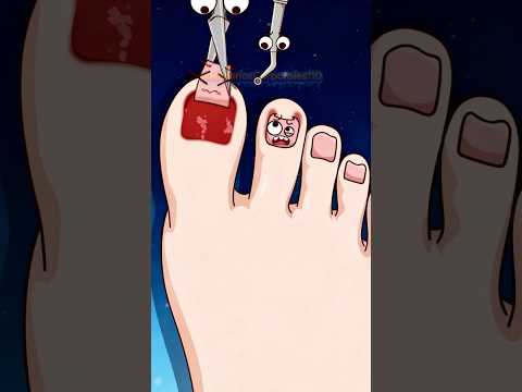 🦶¿Por qué se produce la paroniquia?❓#shorts