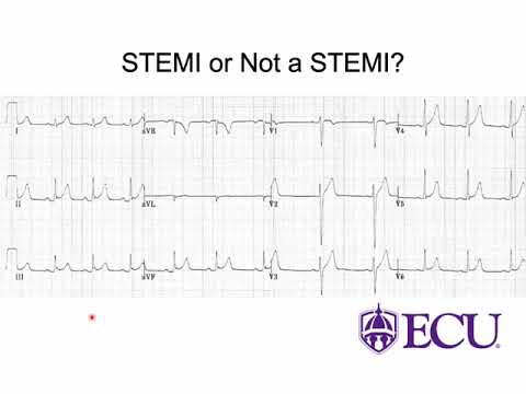 STEMI mimics -  Medical Directors Update 2022