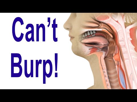 Inability to Burp: Retrograde Cricopharyngeus Dysfunction (R-CPD)