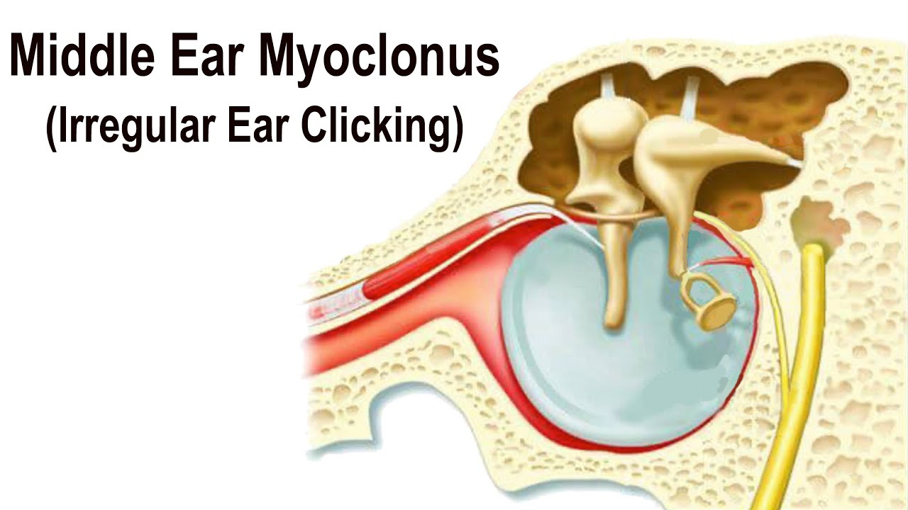 Watch video Middle Ear Myoclonus - Irregular Clicking Sound in the Ear Middle Ear Myoclonus - Irregular Clicking Sound in the Ear