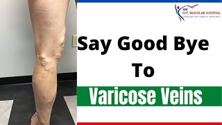 Varicose veins | Treating Varicose veins without surgery in hyderabad