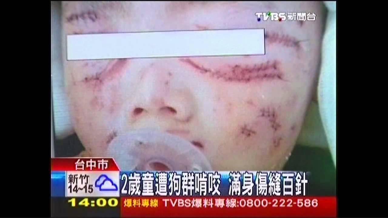 2歲童遭狗群啃咬　滿身傷縫百針