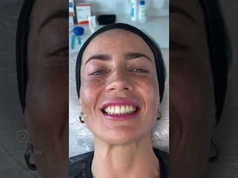 Botox Full Face