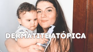 COMO CONTROLEI A DERMATITE ATOPICA DO MEU BEBÊ #dermatiteatópica #inflamaçãonapele #pelesensivel
