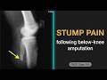 Pain In Amputation Stump In A Male Patient | Rapid Review Case 141