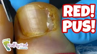 BIG RED TOE WITH PUS SEEPING OUT OF A SEVERE INFECTED INGROWN TOENAIL!