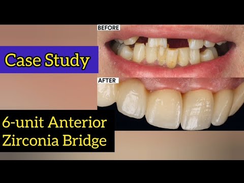 Case Study | Anterior Zirconia Bridge | Metal Free Crowns | Clinical Case Discussion