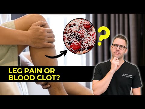 Blood Clot in the Leg or Foot? [Symptoms, Signs, Causes & Treatment]