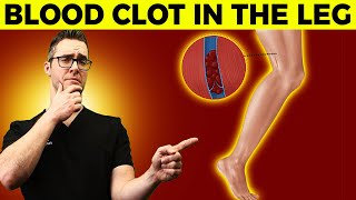 Blood Clot in the Leg or Foot? [Symptoms, Signs, Causes & Treatment]