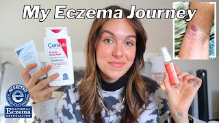 Download lagu HOW I BEAT MY ECZEMA FOR GOOD // My journey, product recommendations,   body care tips | Rudi Berry mp3