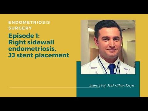 Sidewall Endometriosis