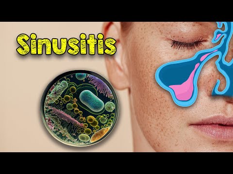 Suffering from persistent sinusitis? Here's how you can get rid of chronic sinusitis without surg...