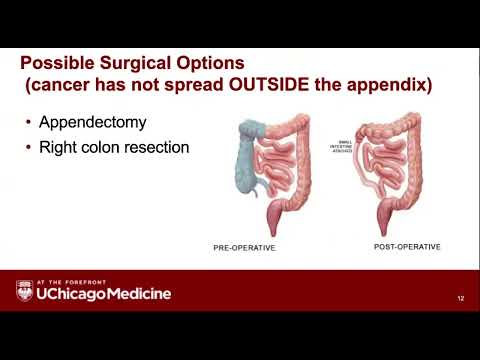 Appendix Cancer 101