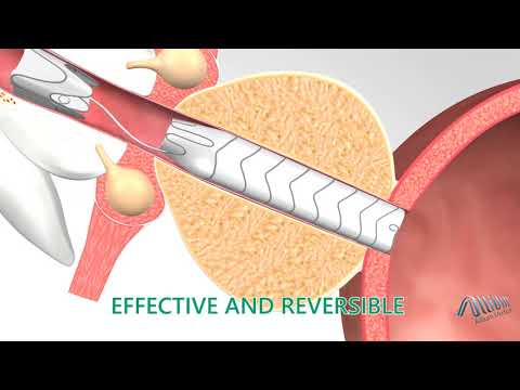 Triangular Prostatic Stents Videos - Allium Medical