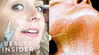 11 Grossly Satisfying Beauty Treatments For Better Skin | Beauty Insider