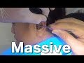 16 Year Old Girl's Massive Earwax Finally Removed