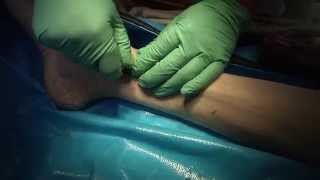 Distal Tibia Interosseous Needle Insertion
