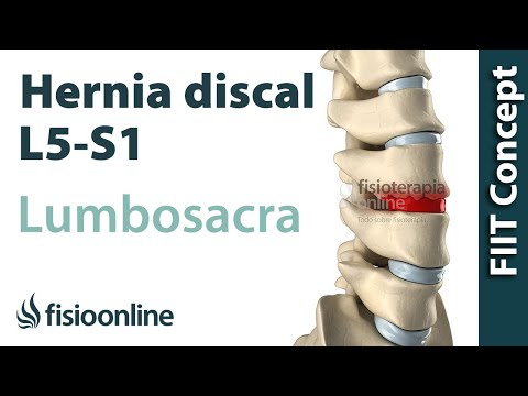 Hernia discal lumbar entre la L5 y S1 o quinta vértebra lumbar y el sacro