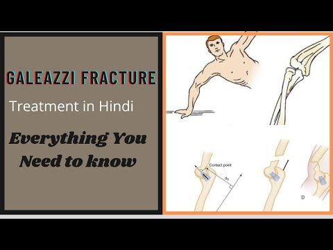 Galeazzi fracture in hindi | forearm Wrist and hand fractures