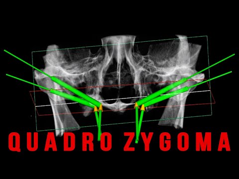 Quadro Zygoma - Full guided protocol
