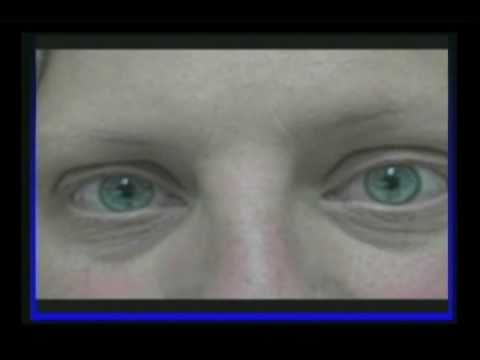 Migrenă oftalmică
