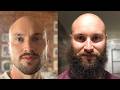 Bald Men Look Most Attractive With A Big Beard
