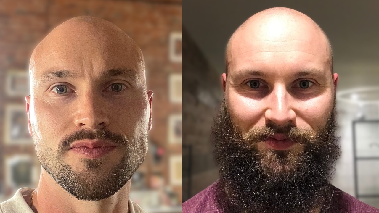 Bald Men Look Most Attractive With A Big Beard?