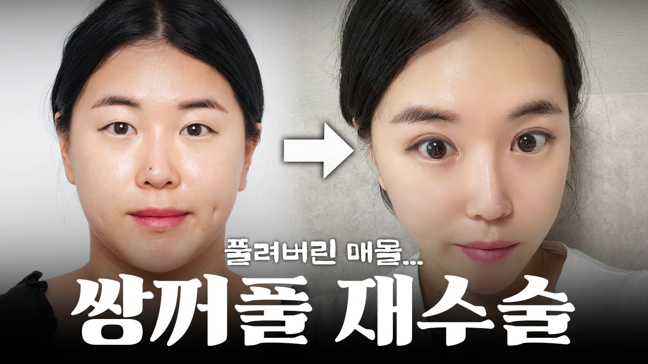 매몰 쌍꺼풀 풀려서 절개 쌍커풀로 재수술