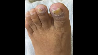 Ep_8299 Foot nails skin removal 👣 นิ้วกลาง..หรือนิ้วอื่นก็เป็นหนังขบได้ 😄 (clip from Thailand)