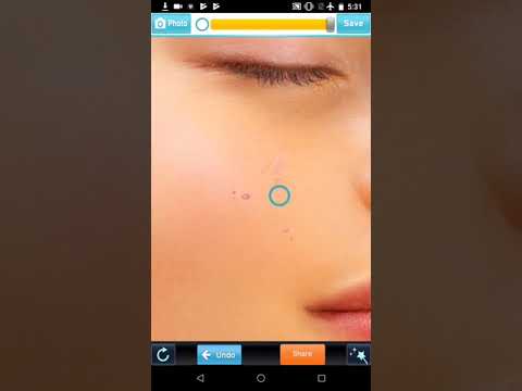 Pimple remover - Acne eraser Video