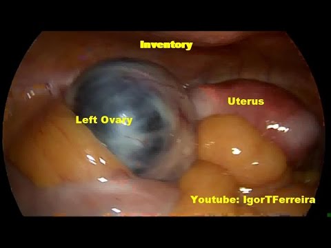 Pinakamahusay na mga artikulo tungkol sa pagbaba ng timbang Turpentine oil para sa pagbaba ng timbang