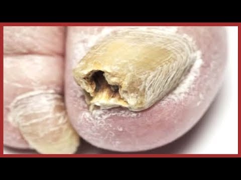Plesnewyje gribok die Nägel Die billige Salbe gegen gribka der Beine