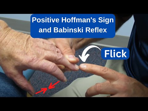Hoffman s sign positive How to perform the test