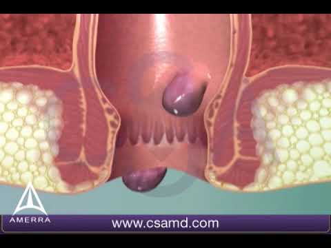 Learn about hemorrhoids with #3d #animation