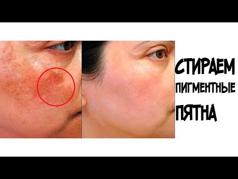 Чистка лица в салоне от веснушек Крем неотон от пигментных пятен купить в москве