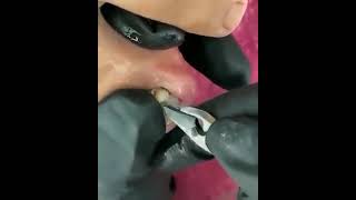 Vídeo de Unha Encravada, Unha Inflamada, Vídeo Satisfatórios