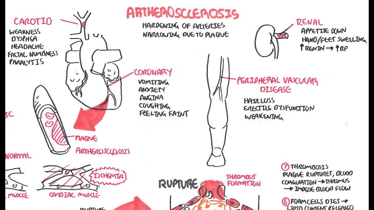 Atherosclerosis - Pathophysiology