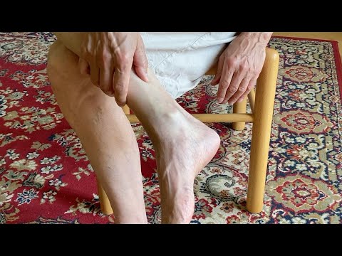 Hogyan lehet eltávolítani a visszerek a lábakon a