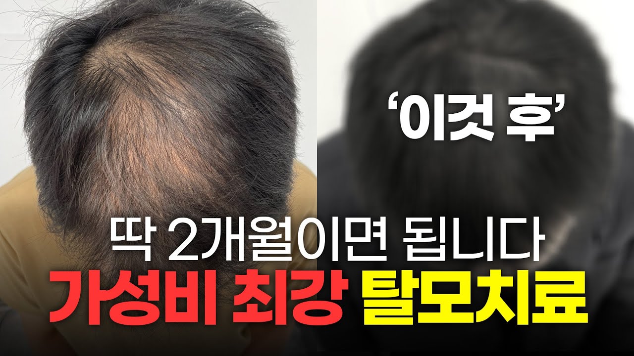 头顶脱发2个月后见效的性价比手术ㅣNew Hair