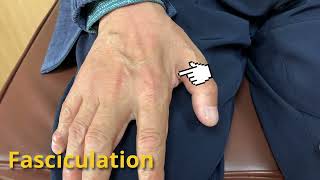 Fasciculation, ALS
