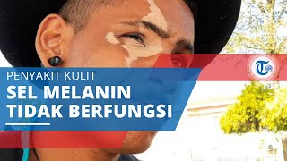 Vitiligo, Penyakit Kulit karena Tidak Berfungsinya Sel Melanin