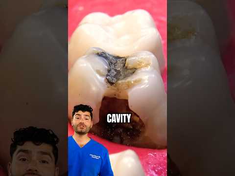 Dentist Explains: How To Fix A Cavity !?