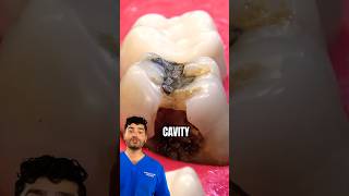 Dentist Explains: How To Fix A Cavity !?