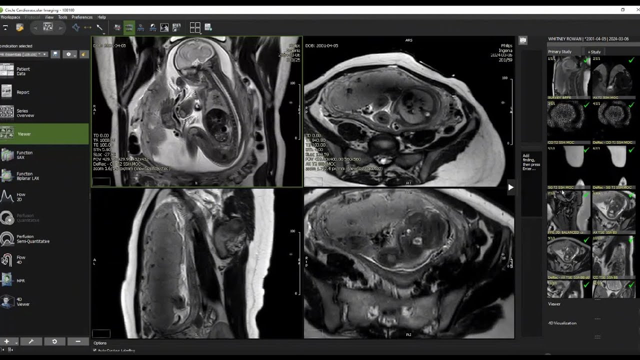 Webinar Summer Session 2024: The Clinical Impact of Fetal Cardiac MRI