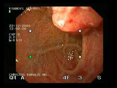 Hyperplastic Polyp In The Duodenum