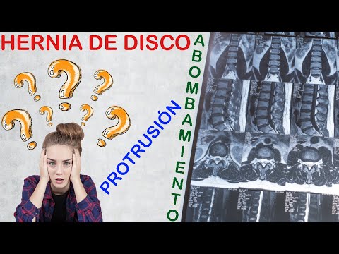 HERNIA DE DISCO | Protrusión | Abombamiento - TRATAMIENTOS NATURALES y efectivos