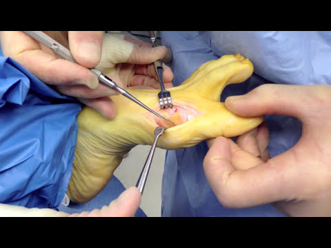 Ask Dr Moore Foot and Ankle FAQ Frequently Asked Questions Video Offering