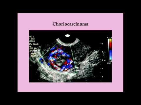 Malignant Gestational Trophoblastic Disease - CRASH! Medical Review Series