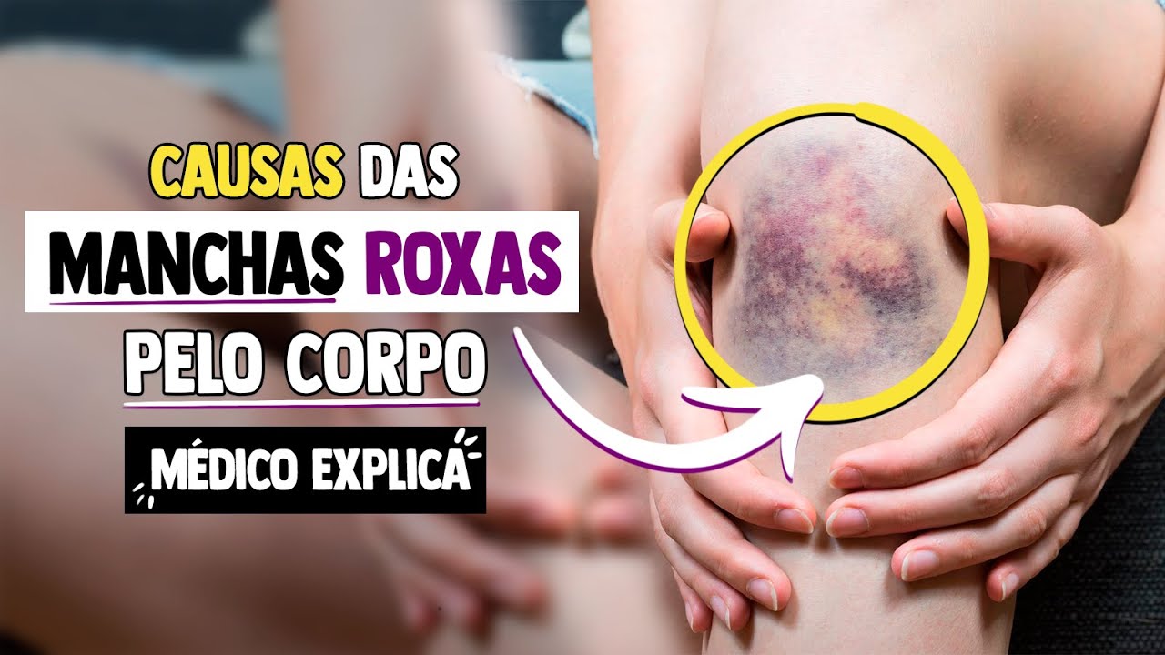 Manchas Roxas no corpo: Causas? Por que aparecem? São perigosas? │ Médico Explica
