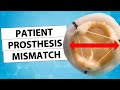 Patient Prothesis Mismatch How To Avoid It